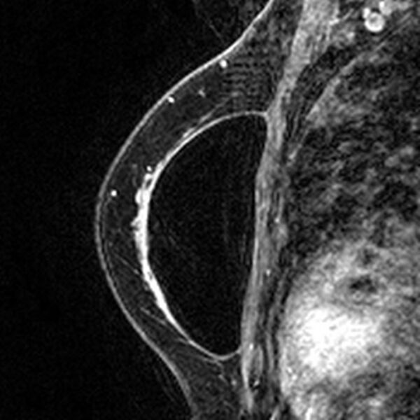 File:Breast implants - MRI (Radiopaedia 26864-27035 Sagittal T2 38).jpg