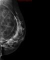 Breast lipoma (Radiopaedia 16321-16004 D 1).jpg