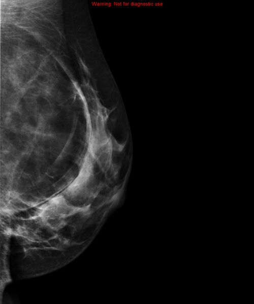 File:Breast lipoma (Radiopaedia 16321-16004 D 1).jpg