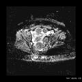 Broad ligament fibroid (Radiopaedia 49135-54241 Axial ADC 16).jpg