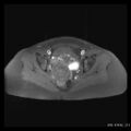 Broad ligament fibroid (Radiopaedia 49135-54241 Axial T1 fat sat 19).jpg