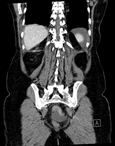 File:Broad ligament hernia (Radiopaedia 84802-100276 B 9).jpg