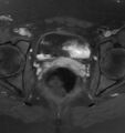 Broad ligament leiomyoma (Radiopaedia 81634-95516 Axial T1 C+ fat sat 19).jpg