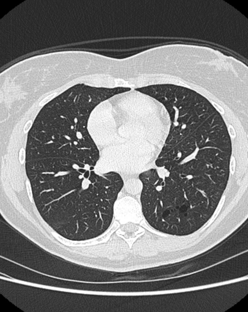 Bronchial atresia (Radiopaedia 50007-55297 Axial lung window 62).jpg