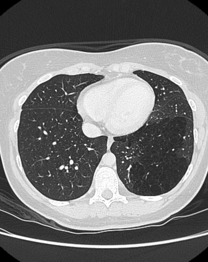 Bronchial atresia (Radiopaedia 50007-55297 Axial lung window 79).jpg