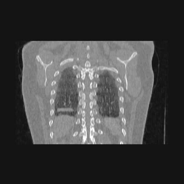 File:Bronchial atresia (Radiopaedia 60685-68439 Coronal lung window 11).jpg