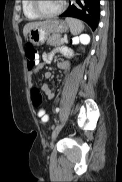 File:Brown tumors compressing the spinal cord (Radiopaedia 68442-77988 F 37).jpg