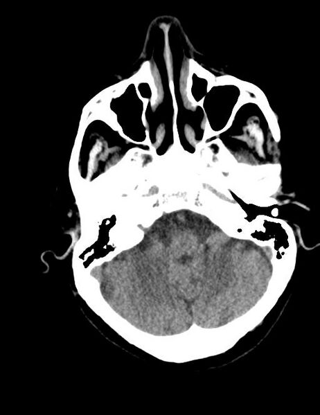 File:Burnt-out meningioma (Radiopaedia 51557-57337 Axial non-contrast 7).jpg