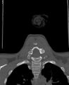 Butterfly vertebra (Radiopaedia 77903-90209 Coronal bone window 53).jpg