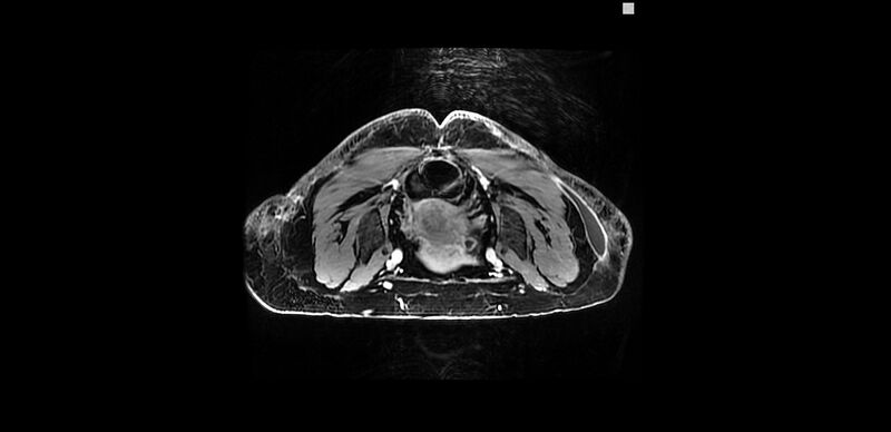 File:Buttock filler complications (Radiopaedia 63497-72115 Axial T1 C+ 17).jpg