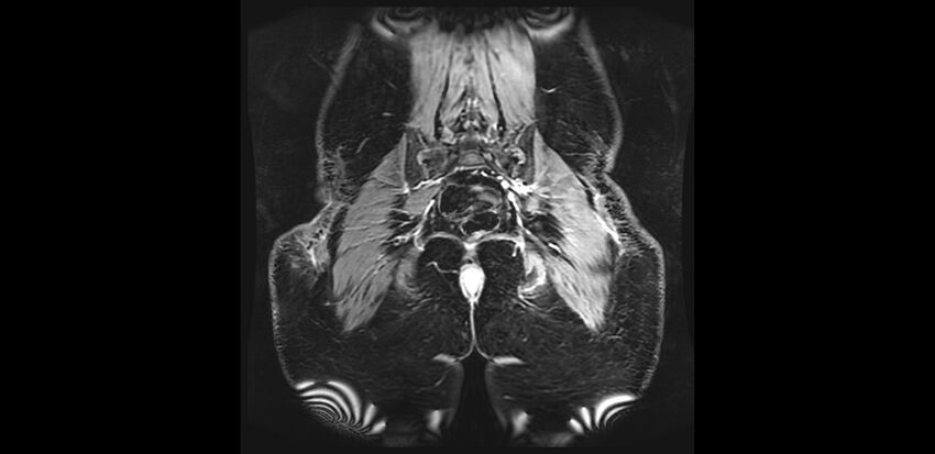 Buttock filler complications (Radiopaedia 63497-72115 Coronal T1 C+ 42).jpg