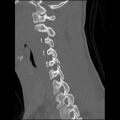 C5 facet fracture (Radiopaedia 58374-65499 Sagittal bone window 30).jpg