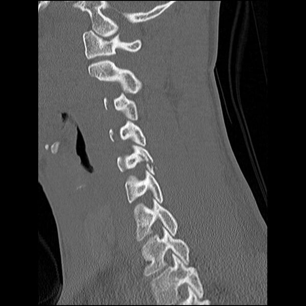 File:C5 facet fracture (Radiopaedia 58374-65499 Sagittal bone window 30).jpg