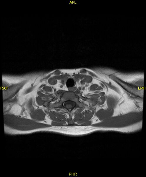 File:C5 nerve sheath tumor (Radiopaedia 85777-101596 Axial T1 23).jpg