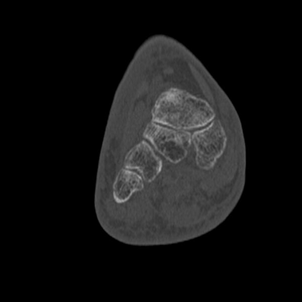 File:Calcaneal tuberosity avulsion fracture (Radiopaedia 22649-22668 Coronal bone window 39).jpg