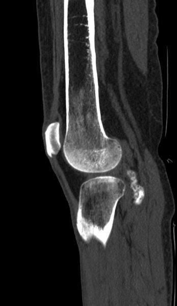 File:Calcified hematoma - popliteal fossa (Radiopaedia 63938-72763 Sagittal bone window 90).jpg