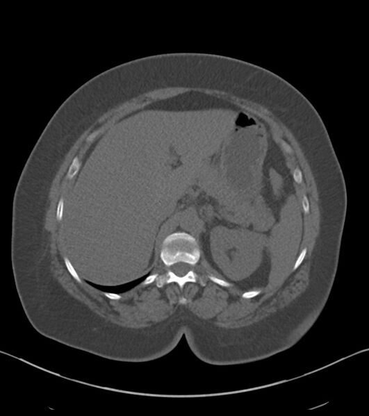File:Calcified hepatic hydatid cyst (Radiopaedia 81127-94738 Axial non-contrast 27).jpg