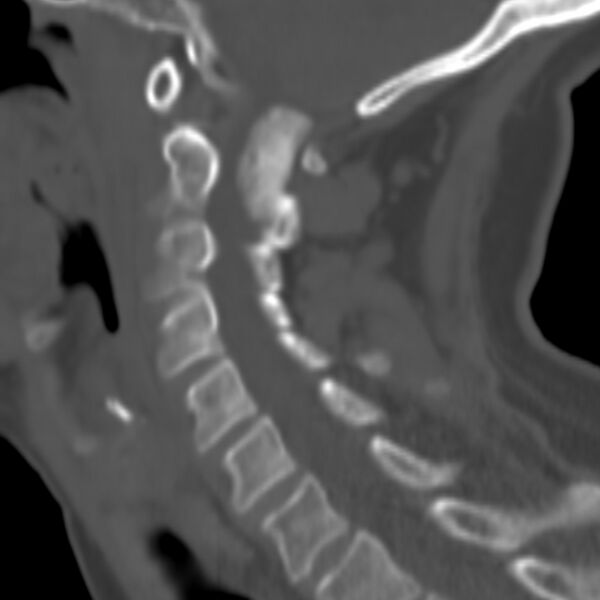 File:Calcified meningioma - cervical canal (Radiopaedia 70136-80171 Sagittal bone window 10).jpg