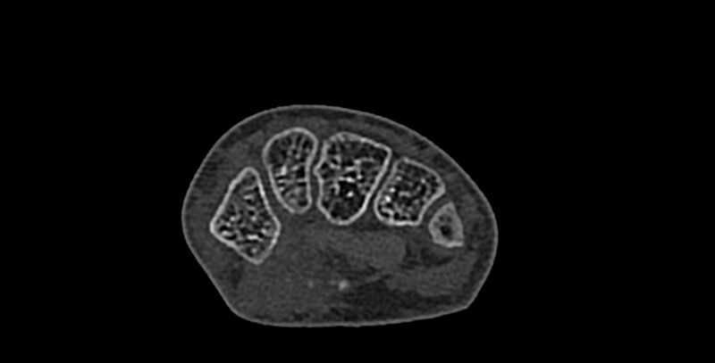 File:Calcifying aponeurotic fibroma (Radiopaedia 88423-105064 Axial bone window 94).jpg