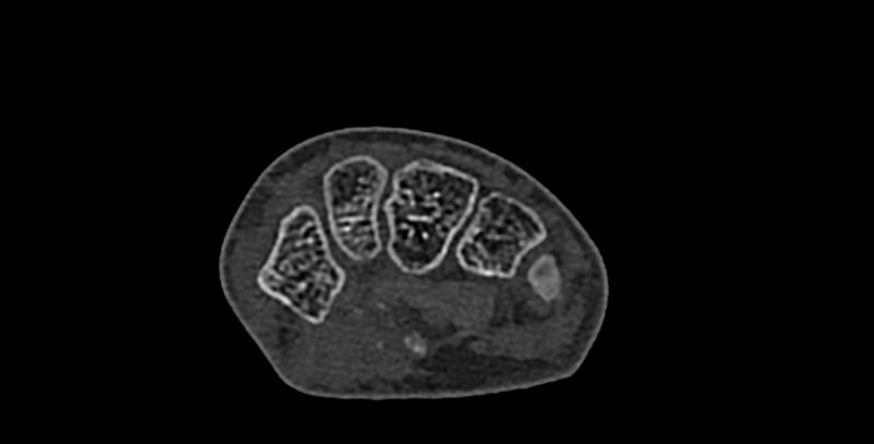 File:Calcifying aponeurotic fibroma (Radiopaedia 88423-105064 Axial bone window 96).jpg