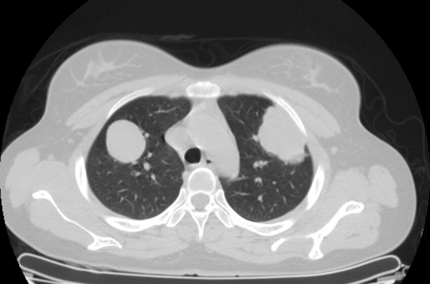 Cannonball metastases - uterine choriocarcinoma (Radiopaedia 70137-80173 Axial lung window 15).jpg