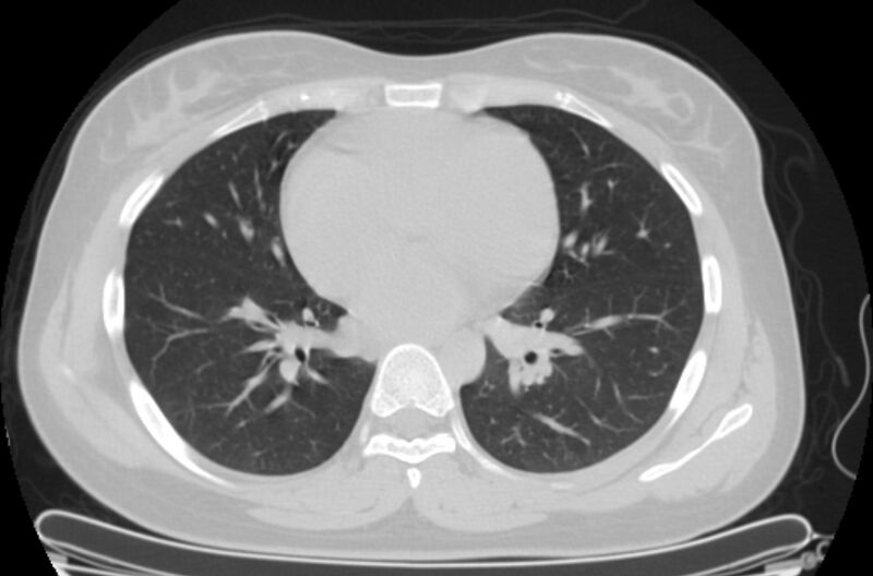 File:Cannonball metastases - uterine choriocarcinoma (Radiopaedia 70137-80173 Axial lung window 61).jpg