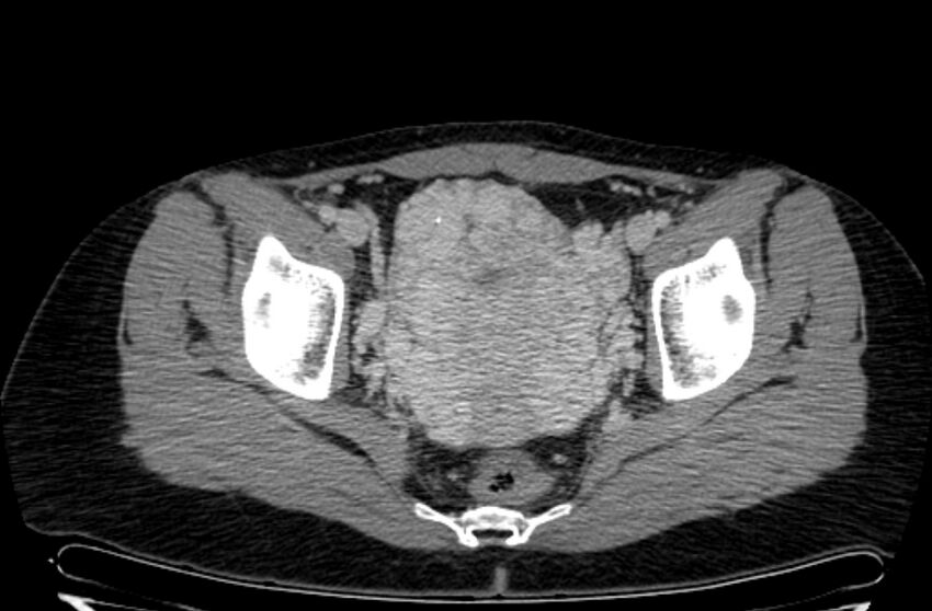 Cannonball metastases - uterine choriocarcinoma (Radiopaedia 70137-80174 A 34).jpg