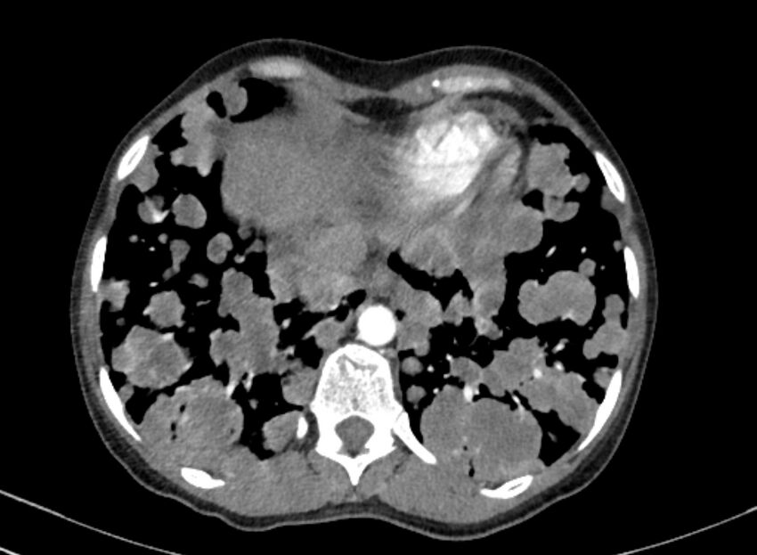 Cannonball metastases from breast cancer (Radiopaedia 91024-108569 A 97).jpg