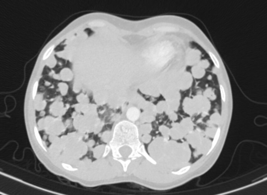 Cannonball metastases from breast cancer (Radiopaedia 91024-108569 Axial lung window 84).jpg