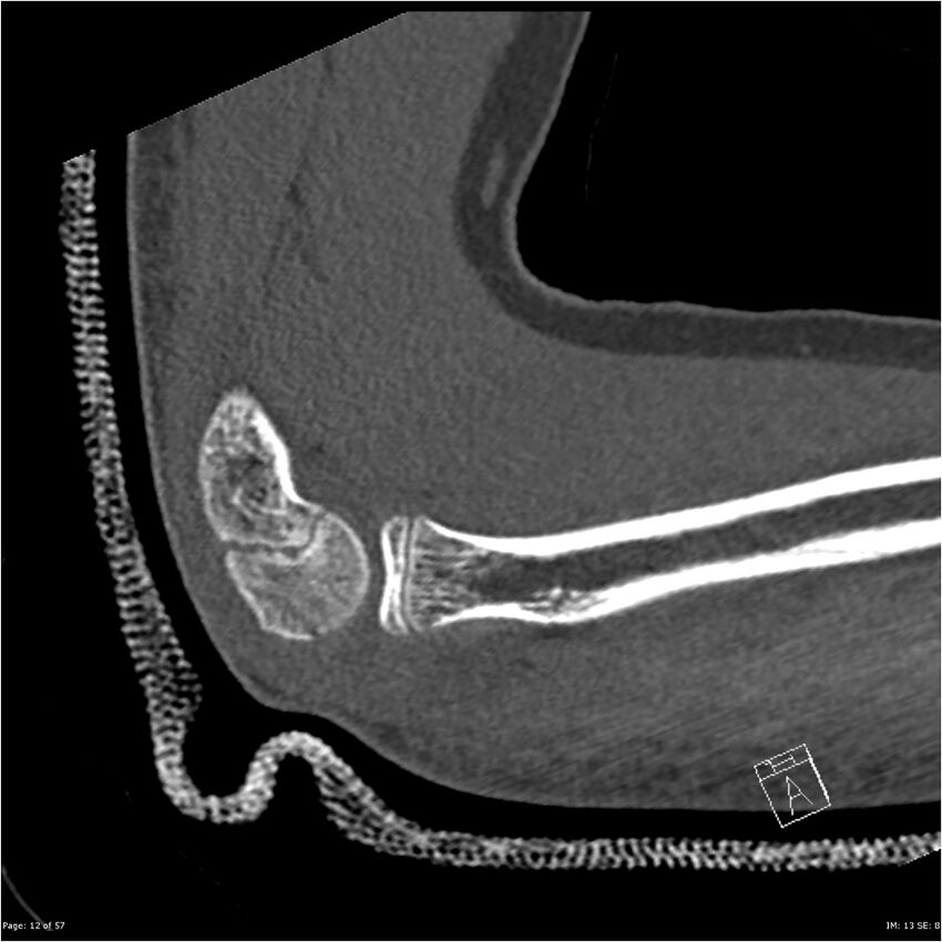 Capitellum fracture (Radiopaedia 23352-23426 Sagittal bone window 12).jpg