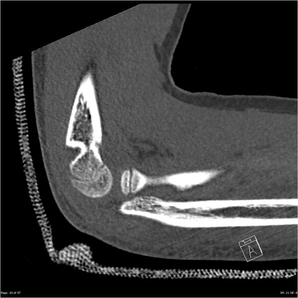 File:Capitellum fracture (Radiopaedia 23352-23426 Sagittal bone window 20).jpg