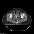 Carcinoma cervix- brachytherapy applicator (Radiopaedia 33135-34173 Axial non-contrast 27).jpg