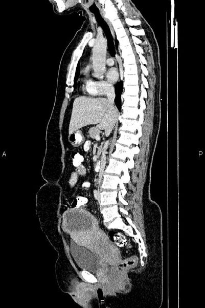 File:Carcinoma of uterine cervix (Radiopaedia 85861-101700 D 39).jpg