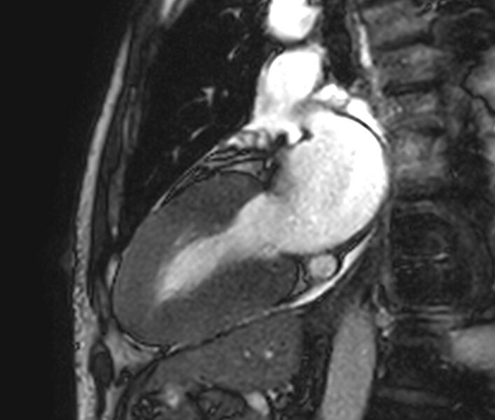 File:Cardiac amyloidosis (Radiopaedia 39736-42124 B 13).jpg