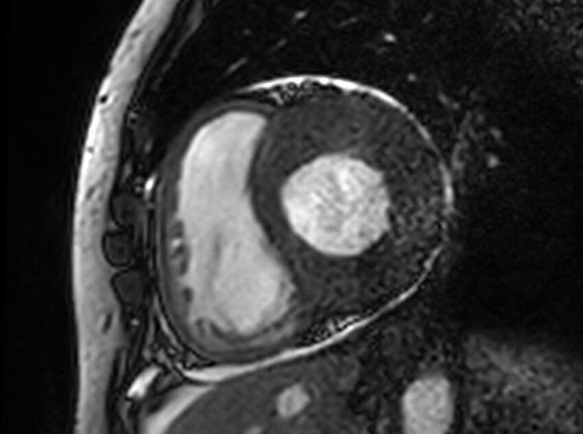 Cardiac amyloidosis (Radiopaedia 61600-69579 Short axis bSSFP 262).jpg