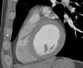 Cardiac hemangioma (Radiopaedia 16971-16679 C 3).JPG