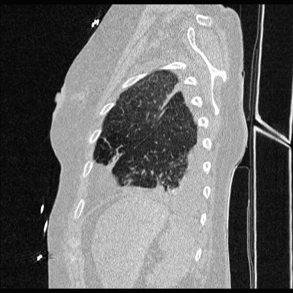 File:Cardiogenic pulmonary edema (Radiopaedia 29213-29609 Sagittal lung window 81).jpg