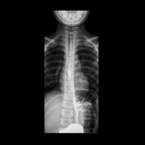 File:Caustic esophageal stricture (Radiopaedia 72422-82955 AP projection 1).jpg