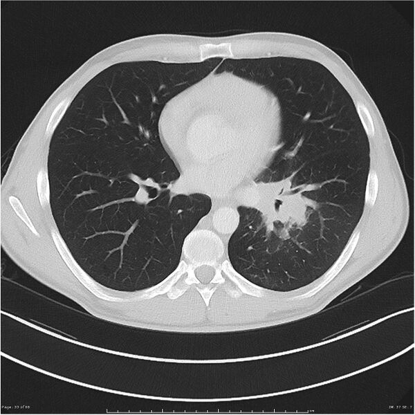 File:Cavitating lung cancer (Radiopaedia 25796-25945 Axial lung window 33).jpg