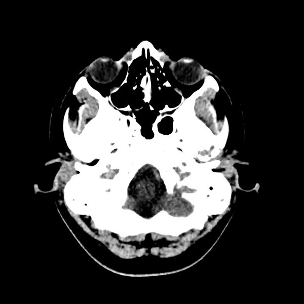 File:Central nervous system Langerhans cell histiocytosis (Radiopaedia 65728-74878 Axial non-contrast 10).jpg