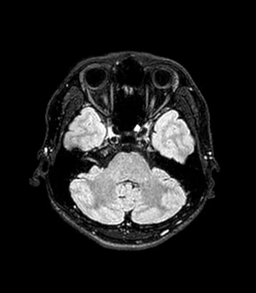 File:Central neurocytoma (Radiopaedia 79320-92380 Axial FLAIR 225).jpg