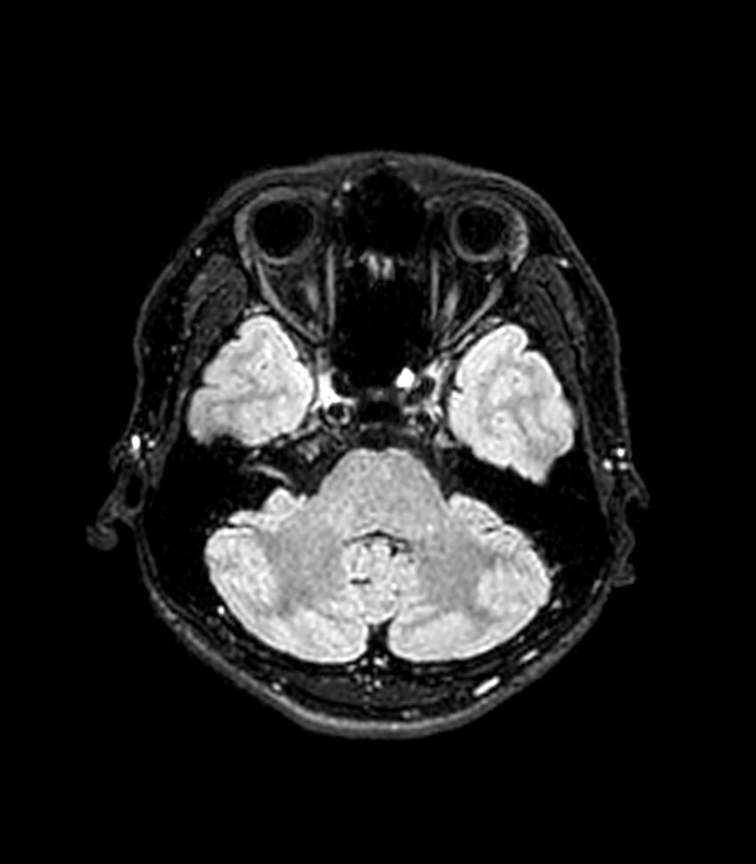 Central neurocytoma (Radiopaedia 79320-92380 Axial FLAIR 225).jpg