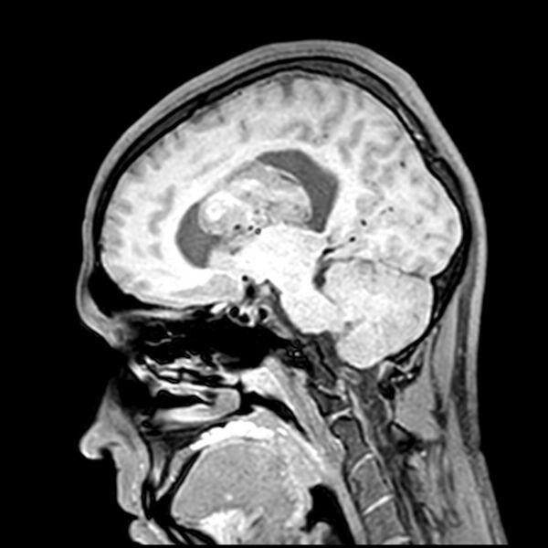 File:Central neurocytoma (Radiopaedia 79320-92380 Sagittal T1 150).jpg
