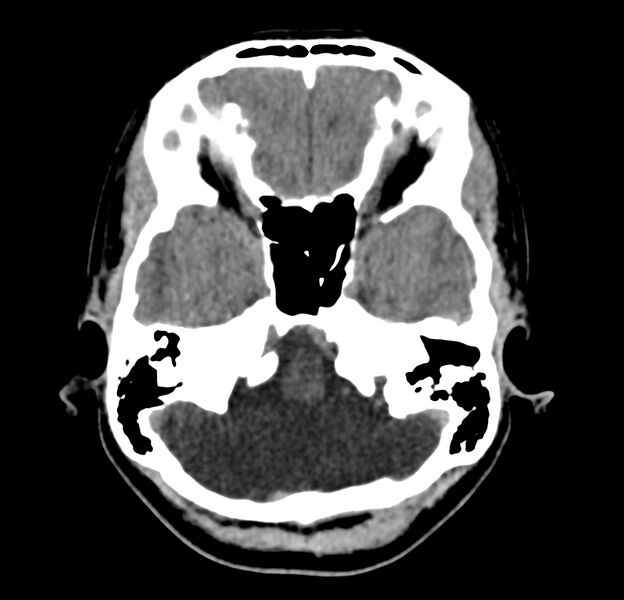 File:Cerebellar agenesis (Radiopaedia 30203-30817 Axial non-contrast 9).jpg