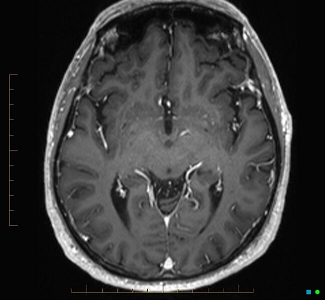 File:Cerebellar gangliocytoma (Radiopaedia 65377-74422 Axial T1 C+ 58).jpg