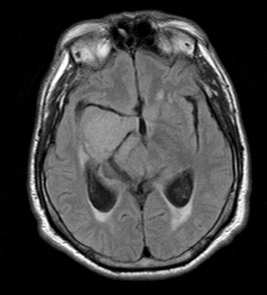 File:Cerebellopontine angle meningioma (Radiopaedia 24459-24764 Axial FLAIR 12).jpg