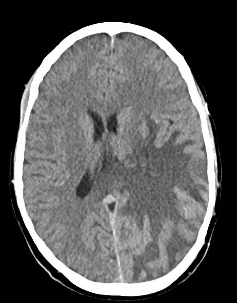 File:Cerebral abscesses (Radiopaedia 70458-80568 Axial non-contrast 36).jpg