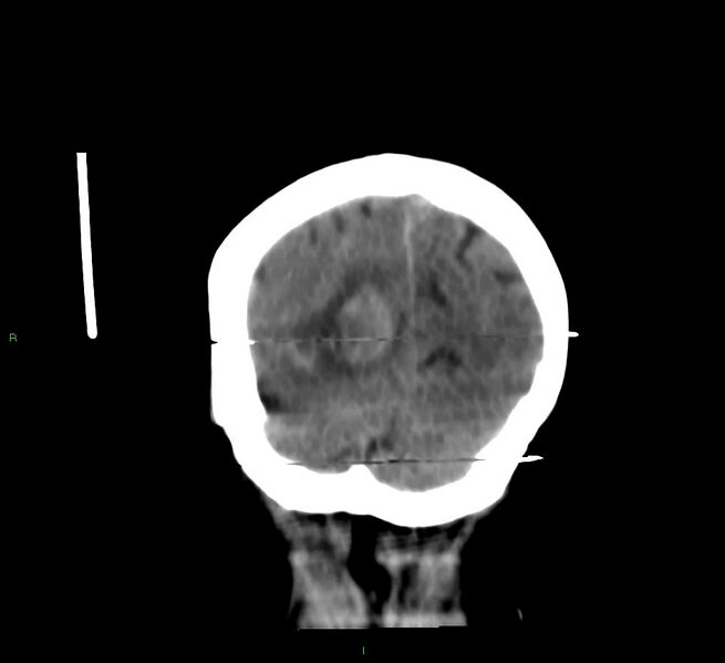 File:Cerebral amyloid angiopathy-associated lobar intracerebral hemorrhage (Radiopaedia 58377-65514 Coronal non-contrast 12).jpg