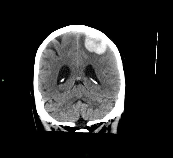 File:Cerebral amyloid angiopathy-associated lobar intracerebral hemorrhage (Radiopaedia 58529-65681 Coronal non-contrast 23).jpg