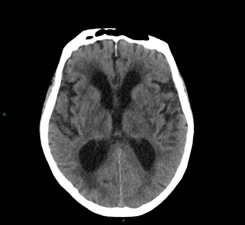 Cerebral amyloid angiopathy-associated lobar intracerebral hemorrhage (Radiopaedia 58530-65688 Axial non-contrast 25).jpg